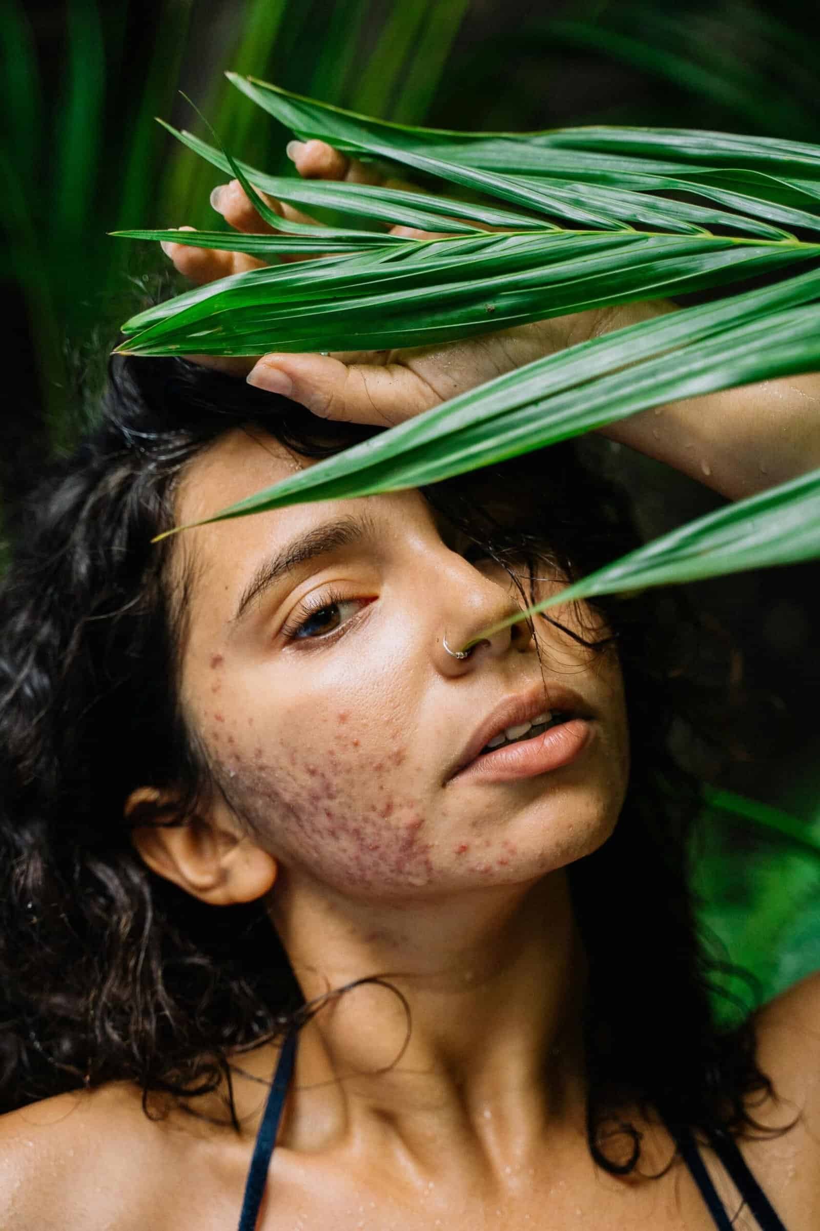 What Causes Acne? The Science Behind Breakouts and the Foods That Trigger Them