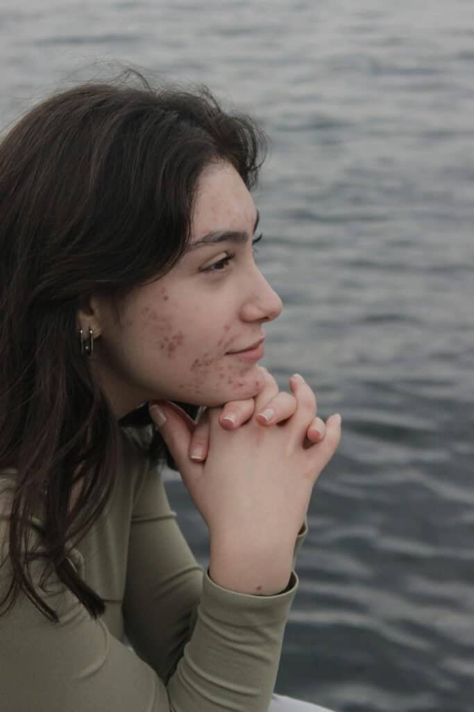 Young woman with acne-prone skin sitting thoughtfully near water with hands clasped, reflecting the emotional and psychological impact of acne on self-confidence and quality of life