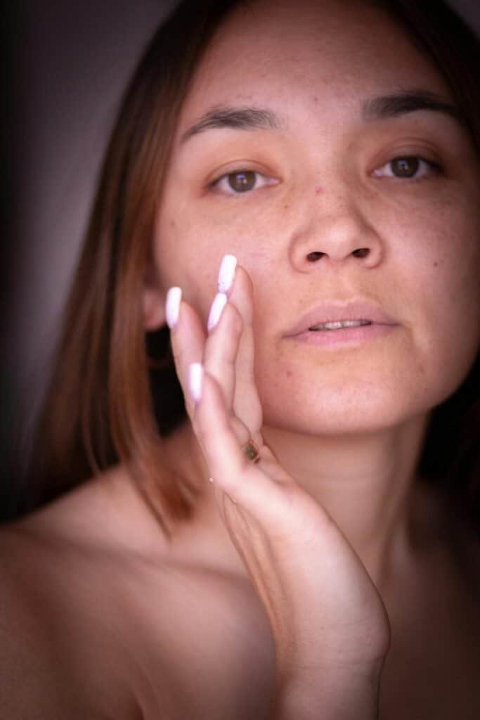 Close-up of a woman with mild acne and blemishes gently touching her cheek, illustrating what causes acne at the skin level through excess sebum and follicular changes