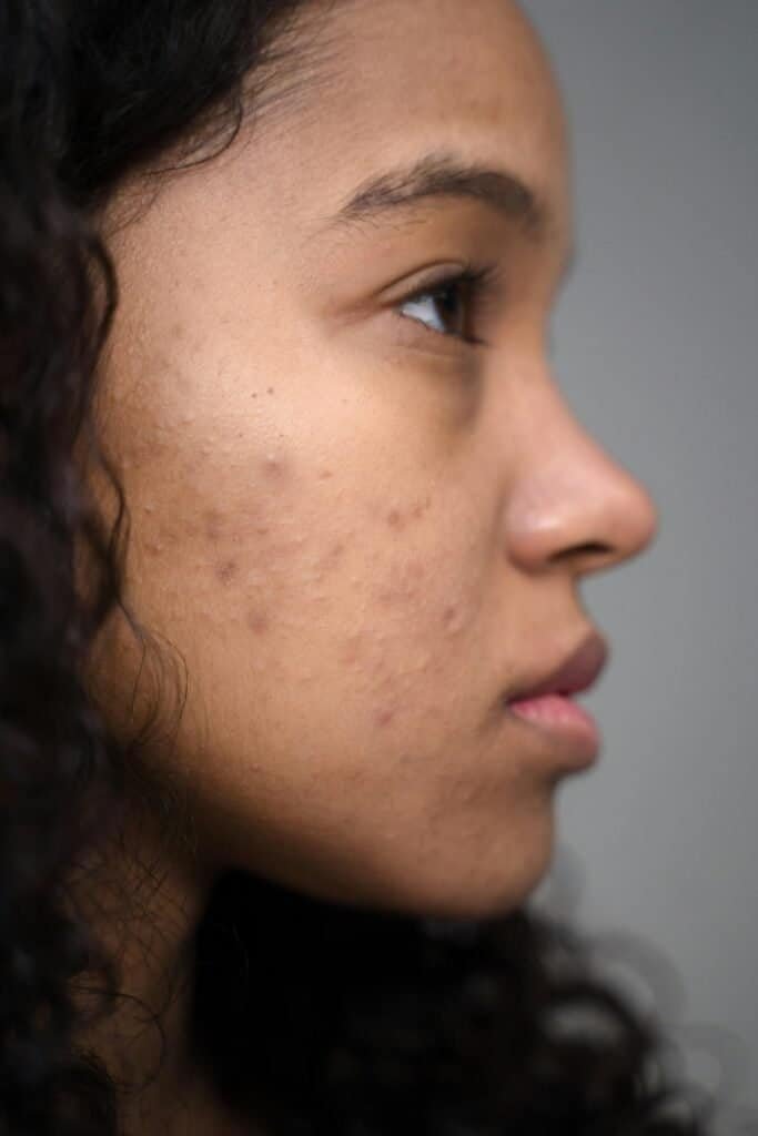 Side profile of a young woman with acne blemishes and post-acne hyperpigmentation on her face, representing the skin condition that botanical ingredients help treat and prevent
