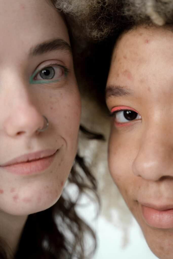 Close-up of two young women with acne-prone skin of different skin tones and ethnicities side by side, representing the diverse audience for this science-backed step-by-step acne skincare routine